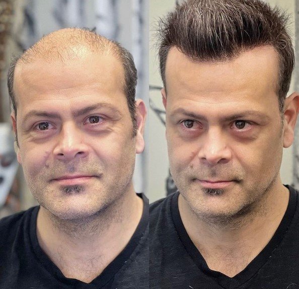 Hair system