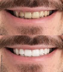 Teeth whitening